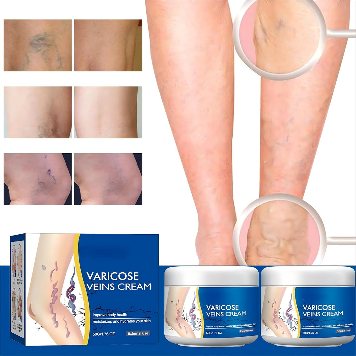 Varicose Veins Treatment Cream for Legs
