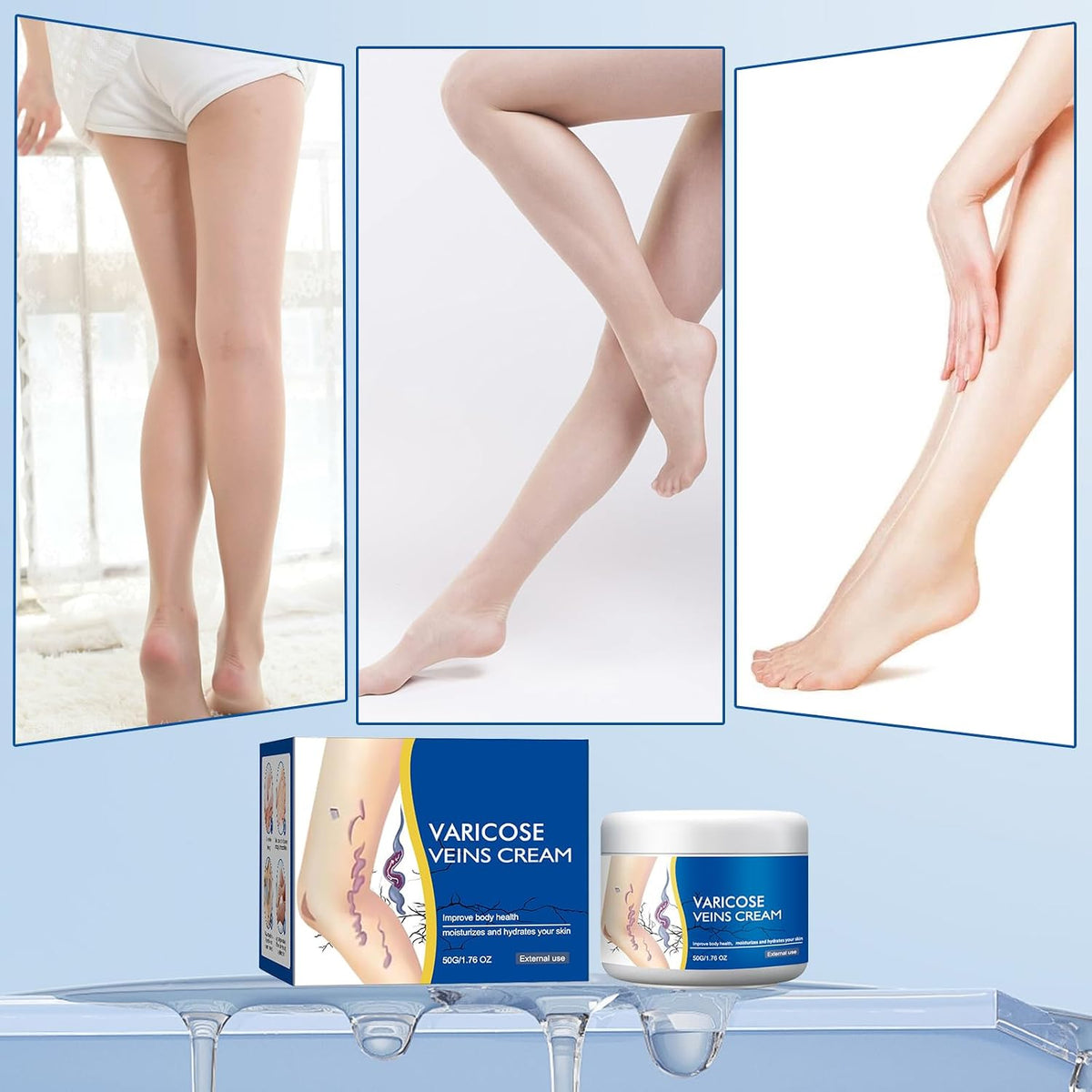 Varicose Veins Treatment Cream for Legs