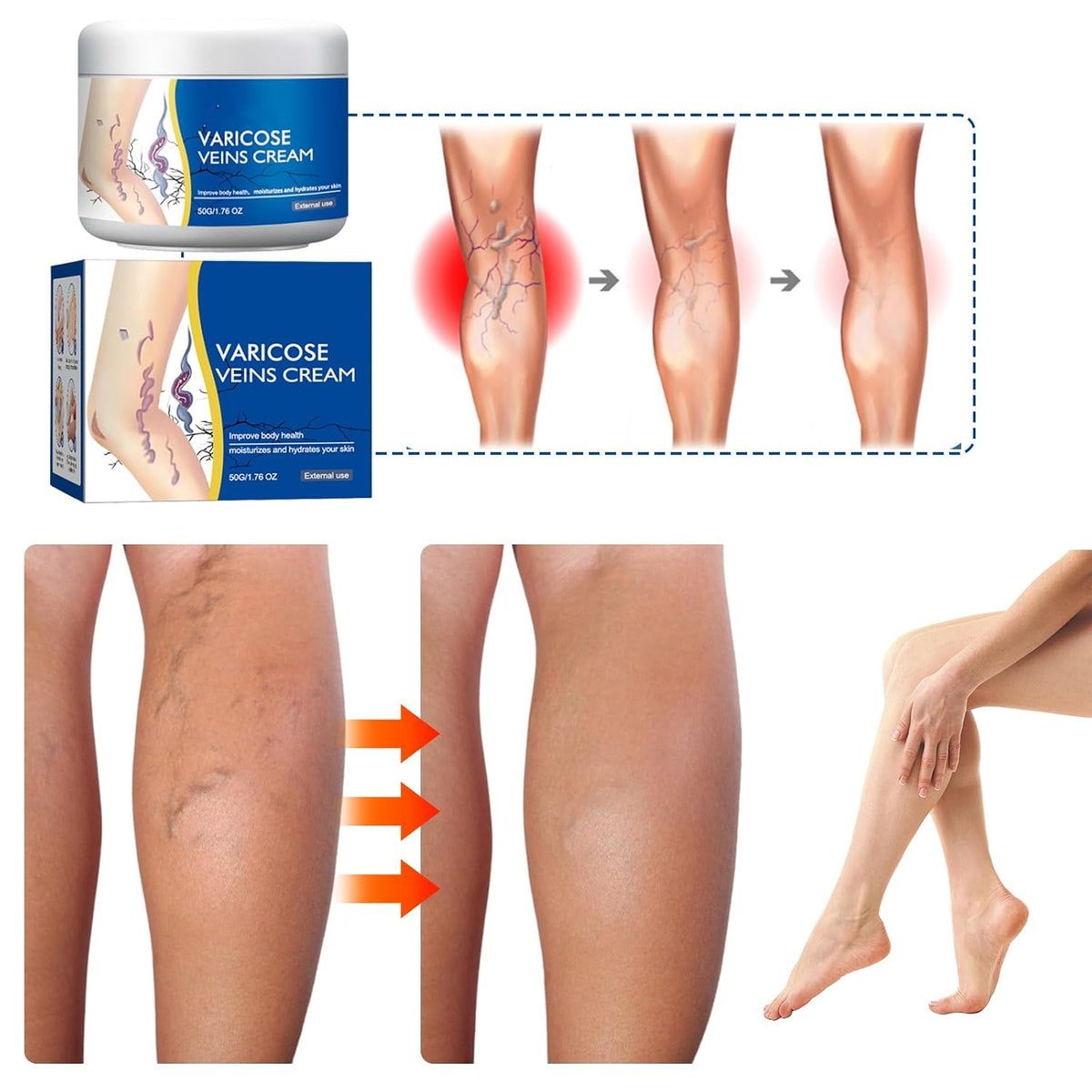 Varicose Veins Treatment Cream for Legs